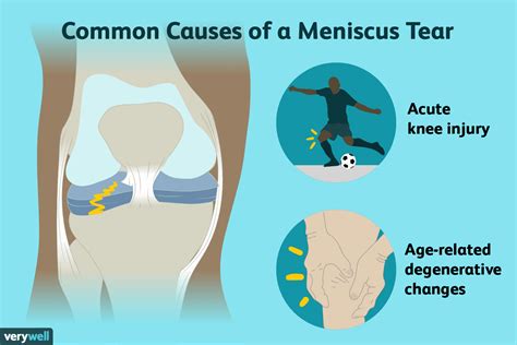 medial meniscus tear